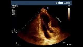 EchoWeb  Left Ventricular Akinesis [upl. by Ettennyl]