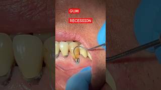 GUM RECESSION Cavity CL 5 Cavities  Tooth Vlog [upl. by Ahsiuq]