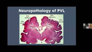 NSGR Vulnerability of the Preterm Brain amp Periventricular Leukomalacia Dr Michael Kruer 81224 [upl. by Rogerson]