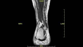 Peroneal Calcaneus internus muscle and Peroneus Brevis tendon split tear  complete MRI examination [upl. by Elfrida640]