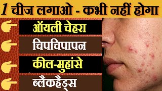 ऑयली स्किन के लिए घरेलू उपाय  Best Face Pack To Cure Oily Skin  oily skin ke liye face pack [upl. by Carly]