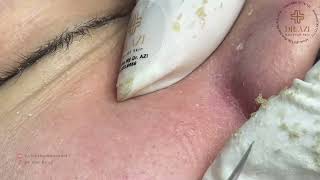 Satisfying Relaxing with Vien Tham My DrAZI vienthammydrazi0049 acne pimples [upl. by Howland]