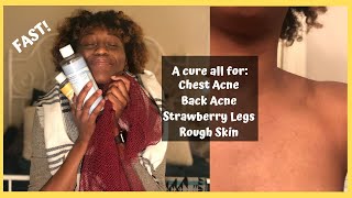 CLEAR BODY ACNE FOREVER How to clear chest acne back acne and strawberry legs Natural Products [upl. by Ostler150]