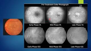 Polypoidal Choroidal Vasculopathy [upl. by Elleiad]