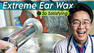 Extreme Ear Wax Removal earwaxremoval earwaxremoving earwax [upl. by Licht]