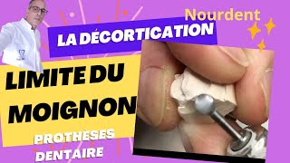 la décortication de la limite du moignon prothèse dentaire [upl. by Euqinim]