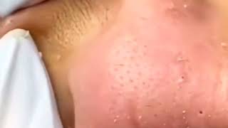 blackheads removal 2023  sac dep spa blackheads removal 2023  skin treatments sac dep spa 2023 44 [upl. by Marciano524]