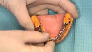 V2551  Predictable Removable Partial Dentures [upl. by Durer916]