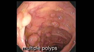 Colonoscopy FollowUp of Colon Polyp  Los Angeles Colonoscopy [upl. by Sokim118]