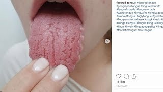 What is a Fissured Tongue Cracked Tongue [upl. by Gene]