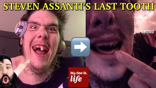 Steven Assantis one last tooth finally came out [upl. by Arekat]