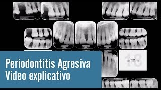 Periodontitis Agresiva  Video explicativo [upl. by Radack417]