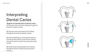 Bitewing Radiographs and their Interpretation [upl. by Llamaj]