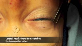 Live Surgery Upper Blepharoplasty Eyelid Lift Part 1 Markings and Anesthesia [upl. by Maurer]