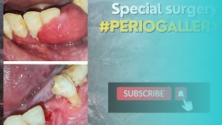 surgical excision of pyogenic granuloma A special surgery youtube [upl. by Layor]