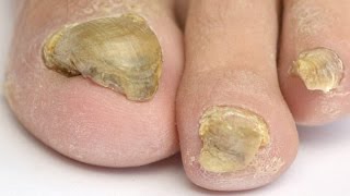 Considering a Laser Treatment For Toenail Fungus Watch This Video FIRST [upl. by Crescen]