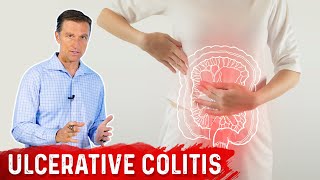 What is Ulcerative Colitis – Causes Symptoms amp Treatment by DrBerg [upl. by Connors]