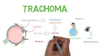 Trachoma  a devastating infectious eye disease [upl. by Evangelist]