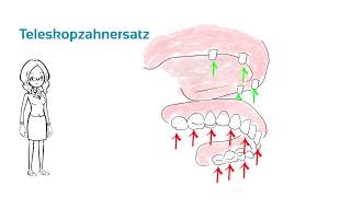 Teleskopzahnersatz  Was ist das  ein Erklärvideo [upl. by Lanni]