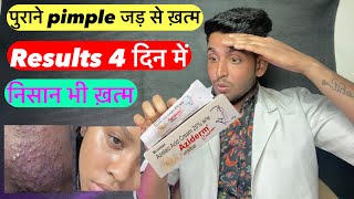 4 दिन में pimple ख़त्म  Aziderm cream review  aziderm cream  aziderm cream 20  Aziderm acid 20 [upl. by Novonod]