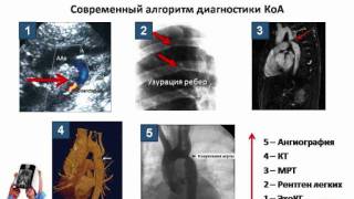 Коарктация аорты симптомы диагностика лечение [upl. by Colvin]