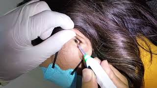 Removing Womans Black Earwax  This is Huge [upl. by Murial]