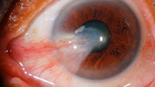 Pterygium Uncovering Causes and Symptomseyedoctor [upl. by Ial918]