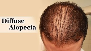 Diffuse Alopecia  Diagnosis and treatment [upl. by Sielen]