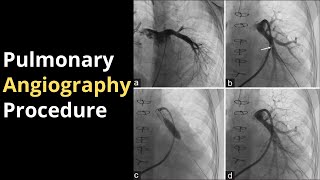 Pulmonary Angiography Procedure Angiogram Balloon Video [upl. by Boni]