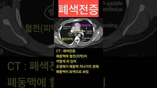 폐색전증 폐혈전색전증 CT 진단 [upl. by Newnorb]