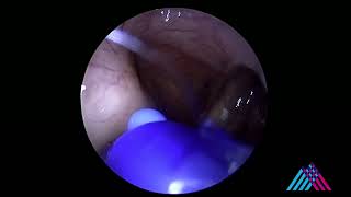 Eustachian tube balloon dilation for eustachian tube dysfunction [upl. by Nylac]