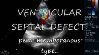 VSDPeri membranus Type ECHOCARDIOGRAPHY SERIES BY DR ANKUR K CHAUDHARI [upl. by Euqinad451]