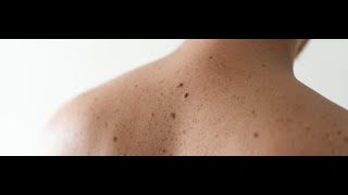 Birthmarks Symptoms and Causes  Diagnosis  Treatment  Prevention [upl. by Denna913]