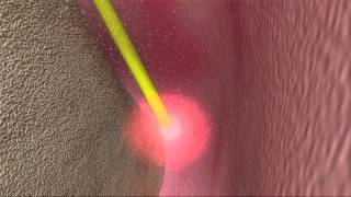 Laser Periodontal Therapy  WPT™ Animation [upl. by Holton]