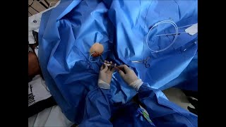 PTGBD insertion Cholecystostomy tube insertion 경피적 담낭조루술 [upl. by Takeshi]