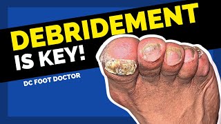 Debridement Is The Key [upl. by Efron352]