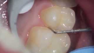 Whats the gary shadow on my tooth Premolar Series 2 of 3 [upl. by Emily145]