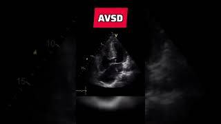 Atrioventricular septal defect  congenital heart defect echocardiography AVSD [upl. by Januarius802]