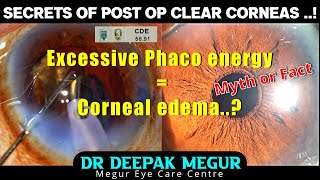 Excessive Phaco Energy During surgery Does it cause Post Op Corneal edema Dr Deepak Megur [upl. by Bastien]