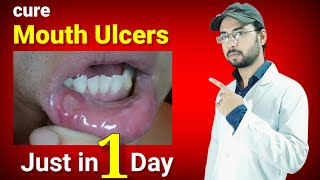 cure mouth ulcers just in one day permanently  mouth ulcer home remedy  canker sore home remedy [upl. by Ettevol685]