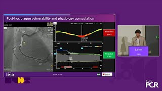 Artificial intelligencepowered quantification of coronary physiology and vulnerable plaque [upl. by Aicelet]