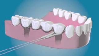 TePe Bridge amp Implant Floss  für die Reinigung um die Implantate [upl. by Ardnahc]