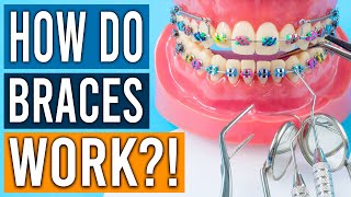 How Do Braces Work [upl. by Cari132]