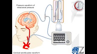 Intracranial Pressure 2 Monitoring ضغط المخ [upl. by Mouldon643]