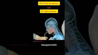 NG  Nasogastric  Tube Insertion Techniquen In Hindi ll RT Tube Insertion Procedure ll SG Pharma [upl. by Renado681]