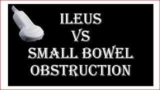 Ultrasound of ileus VS small bowel obstruction [upl. by Silvie380]