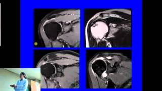 Resonancia Magnética Nuclear en Hombro [upl. by Robby]