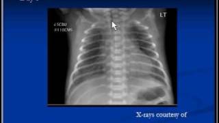 Chest xray interpretation Respiratory distress syndrome [upl. by Attlee]