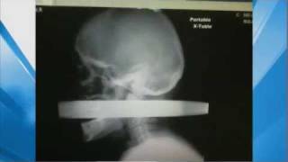 XRay Man Impaled by Pipe in Head Survives [upl. by Mollie124]