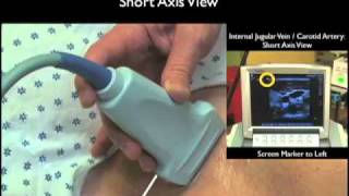 How To Ultrasound Guidance for Central Venous Access Part 1 Case Study [upl. by Wareing]